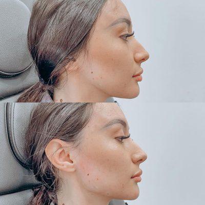 Just look at these results of Jawline Contouring.⁠