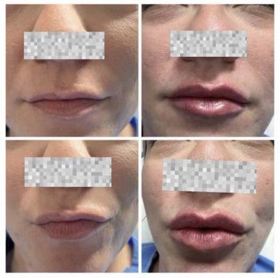 Lips Filler