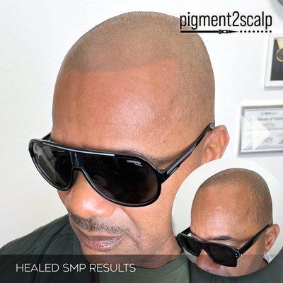 The Hair Tattoo (Scalp Micropigmentation SMP) is a great hair loss solution for people with all types of skin tones.