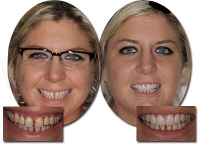 4 EasySmile Veneers to close unwanted spaces, 1 short visit, very affordable!