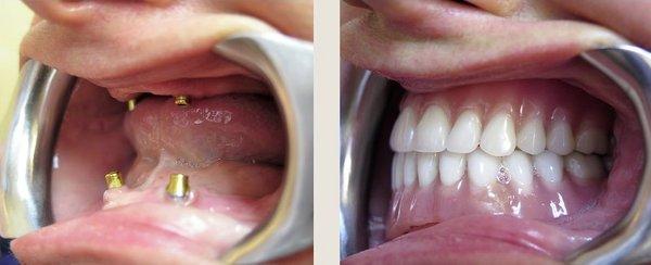 All On 4 dental implants are a convenient and cost effective full mouth reconstruction option.