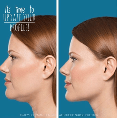 Treatment: Submental fat reduction How it works: Kybella injections Results: Seen at 4-6 weeks