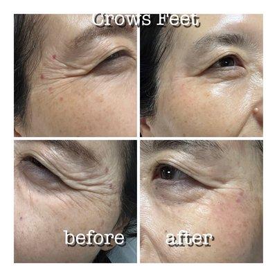 Crows Feet treated with Botox