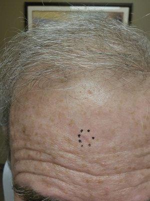 location of Basal Cell Carcinoma (BCC) for MOHS surgery