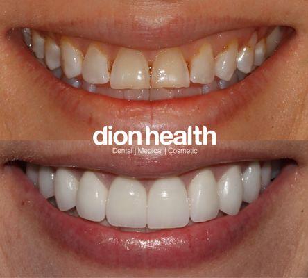 before and after of porcelain veneers