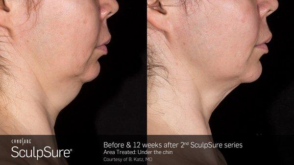 SculpSure Submental Treatment