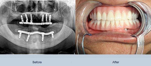 Full mouth implant rehabilitation