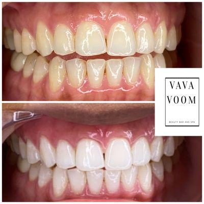 Before and After Teeth-whitening 60min session.