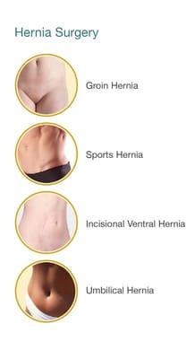 Repair of Inguinal (groin), Umbilical (belly button), Hiatal, Incisional ventral, and Sports hernia