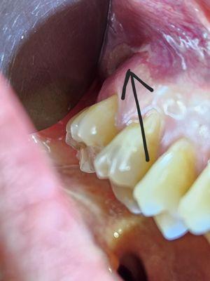 Infection and yellow and white stuff forming.