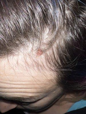 That's the mole I have had on my head for years! Worst spot ever to get one!