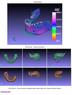 Computer generated fully guided dental implants