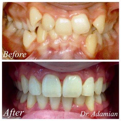 Before and after with braces treatment