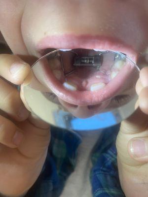 the wire on the right side is buried in the roof of his mouth from the retainer.