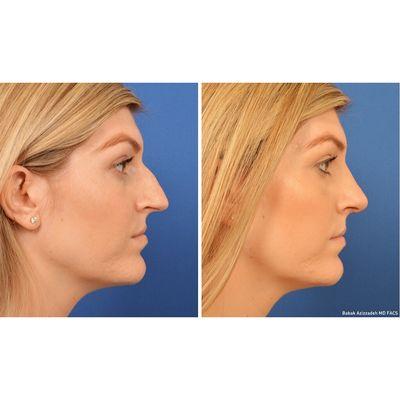 Best nose job results