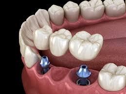 Two or more implants are used to support a section of false teeth & can support an implant bridge or other restoration.