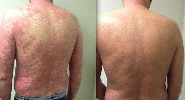 Psoriasis before and after phototherapy treatment.