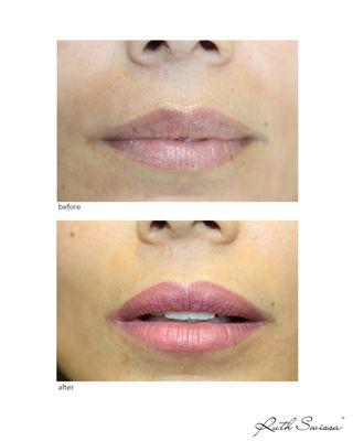 Permanent lip blush (permanent lipstick / lip-neutralization / lip lightening) to make the lips appear fuller, more vibrant.