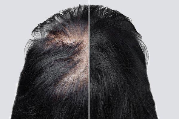 PRP Treatment for hair loss is a proven non-surgical way to reduce and reverse hair loss.