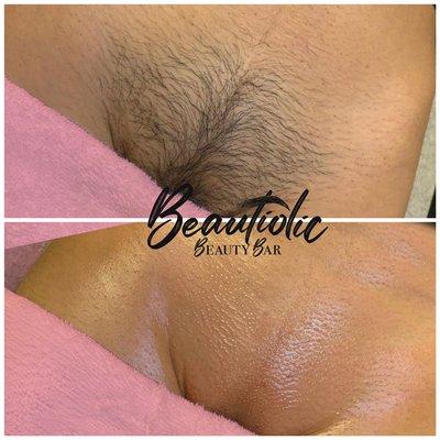 Brazilian wax