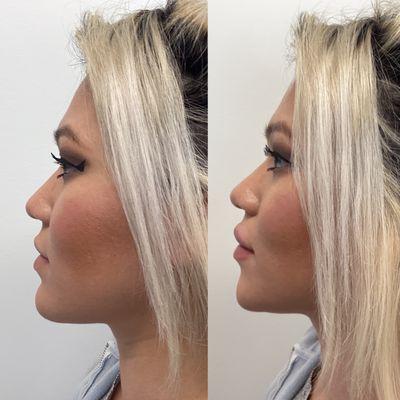 Before & After lip and chin filler