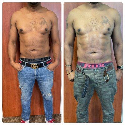 Before/After 2nd session Radio Frequency Abdominal Treatment