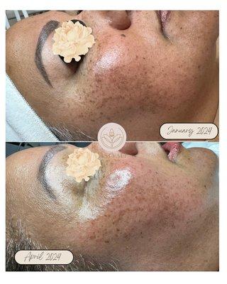 Brightening Facial