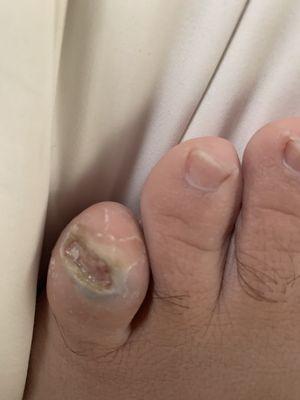 Toe nail