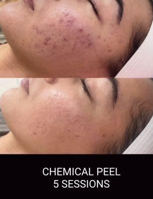 Amazing result Chemical peel