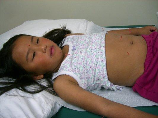 Acupuncture for a child