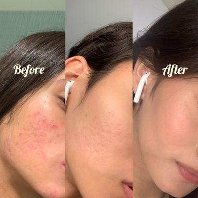 Results after three Microneedling treatments it improves acne scars and reduces large pores