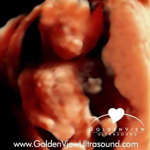 HD Live image captured at Goldenview Ultrasound at 17 weeks