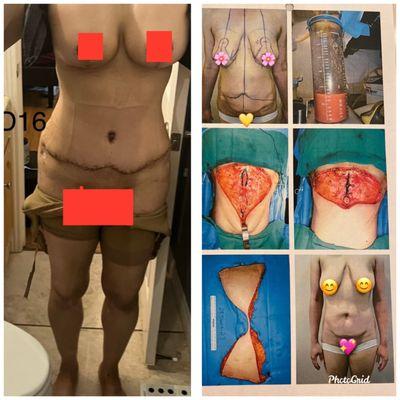 Mommy makeover Breast Augmentation, breast lift, Liposuction, Tummy tuck, muscle repair