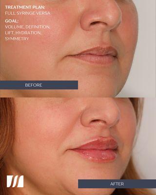 Full syringe of Versa. Our patient wanted to shorten her philtrum and achieve height and fullness of the lips.