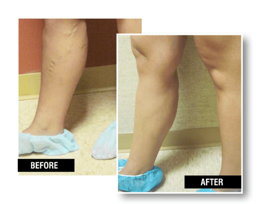 Endovenous Laser Therapy before and after