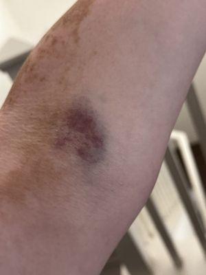 Bruised on arm after getting blood out