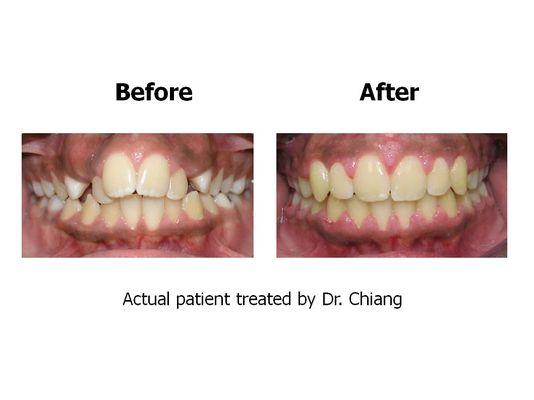 Actual patient treated by Dr. Chiang