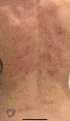 Photo of my back an hour later for reference