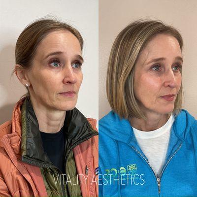 Sculptra results. Two sessions.