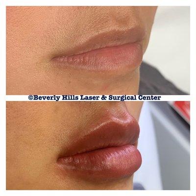 Before and after 1 syringe dermal fillers