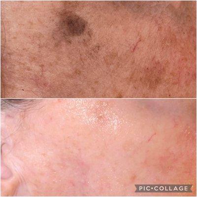 After only one treatment for brown spot removal. I was skeptical because of the previous one star review,  but I am beyond satisfied.