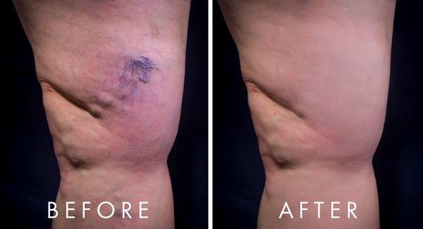 Vein treatment / removal patient before and after results. Contact us to learn more