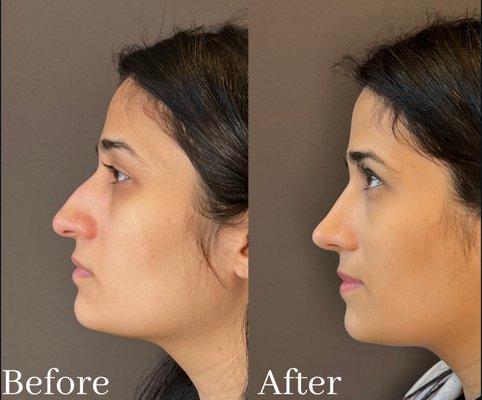 Female 3 Months  After Closed Rhinoplasty