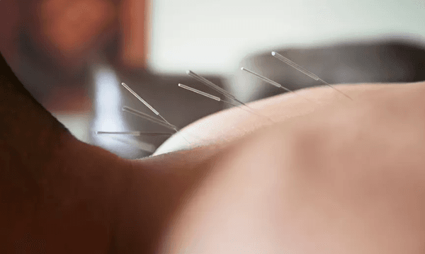 Oriental Day Acupuncture