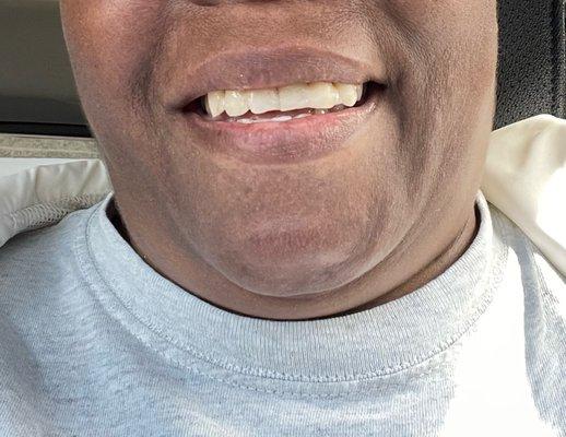 After front teeth extraction, a temporary replacement on the same day.