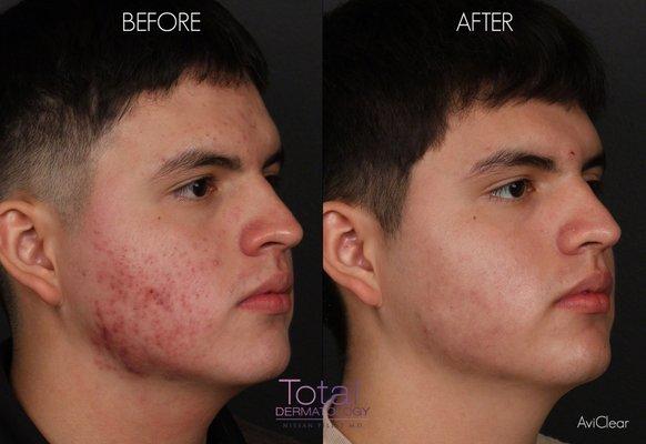 Patient was treated with the AviClear laser for acne.