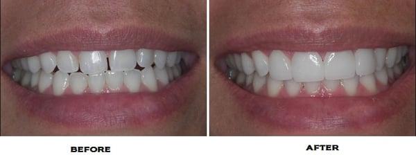 Veneers - Before & After