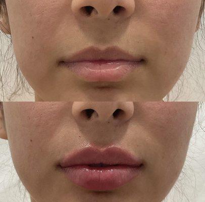 Lip filler done by Nurse Darlene!