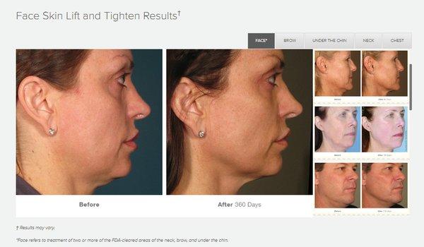 Temecula Botox Wrinkle Removal Face Neck Tightening Fillers Ultherapy