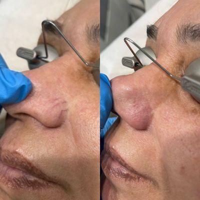 Spider Vein Removal